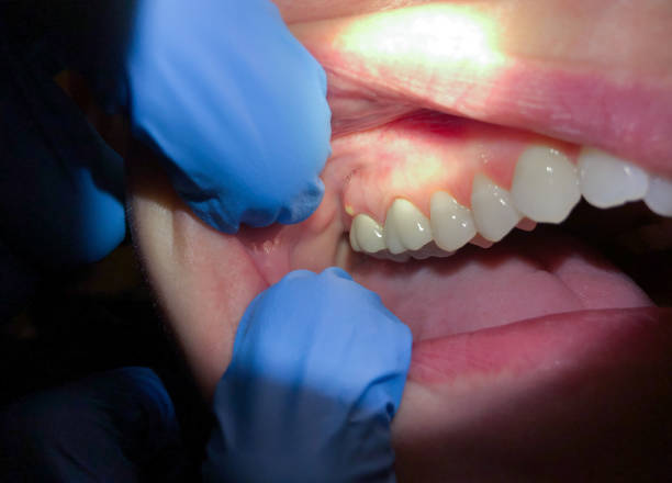 Best Dentist for Tooth Abscess  in Rheems, PA